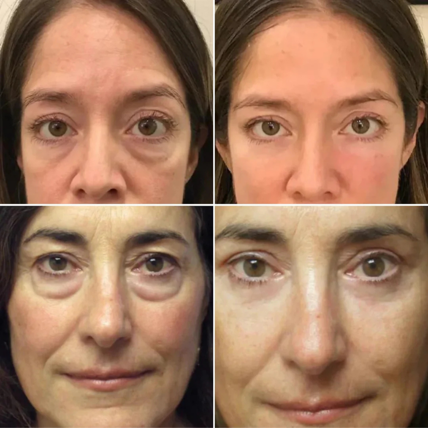 Serum quita Ojeras OUHOE